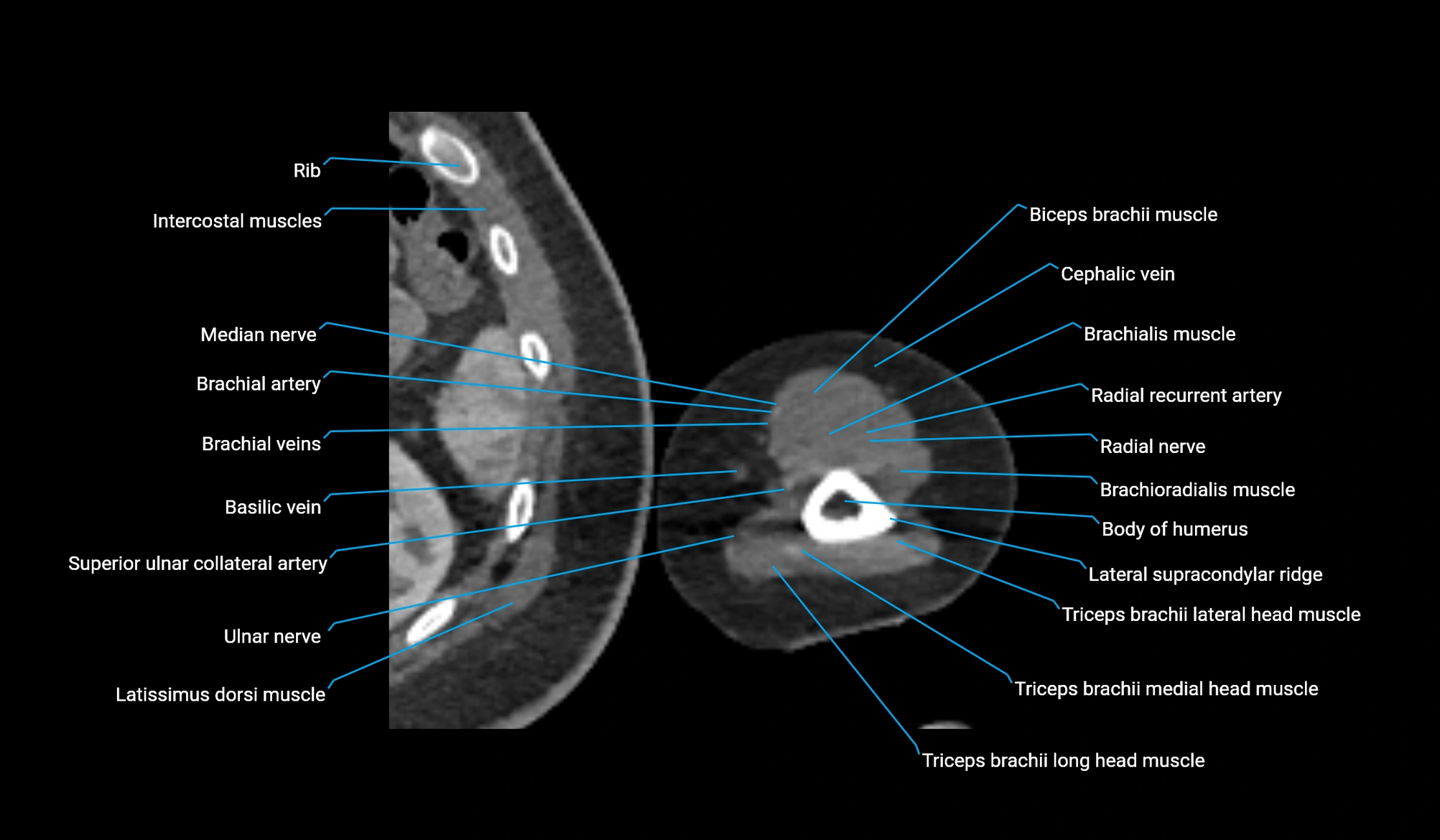 CT upper arm axial  cross sectional anatomy labelled radiology image -00336.webp